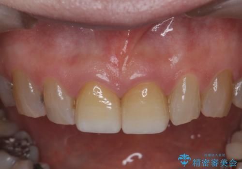 目立つ前歯の変色を改善したいの症例 治療後