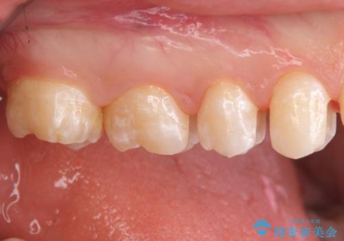 放置した虫歯 セラミックインレーでの治療の治療中