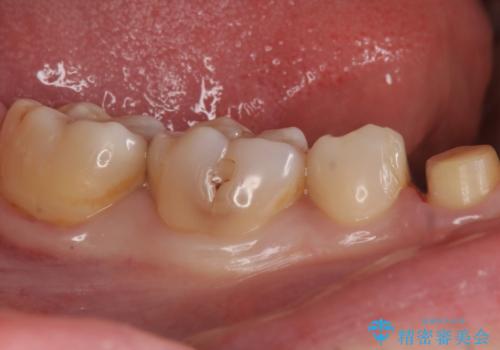 銀の詰め物をオールセラミックで白くしたいの治療中