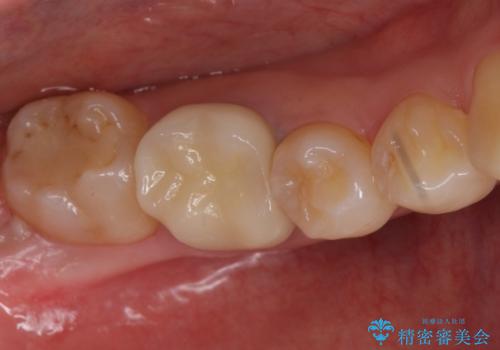銀歯を白くしたい　セラミッククラウンでのやり替えの症例 治療後
