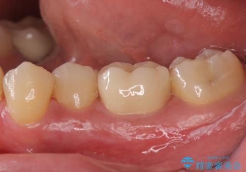 奥歯の詰め物の変色 セラミッククラウンでのやり替えの症例 治療後
