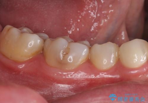 銀の詰め物をオールセラミックで白くしたいの治療後