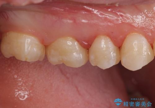 放置した虫歯 セラミックインレーでの治療の治療後