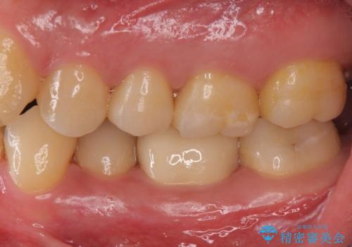 奥歯の詰め物の変色 セラミッククラウンでのやり替えの治療後
