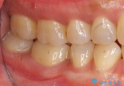 欠けた詰め物 セラミッククラウンでの修復の治療後