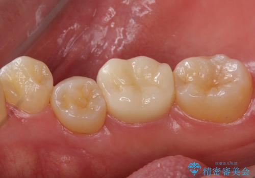 奥歯の詰め物の変色 セラミッククラウンでのやり替えの治療後