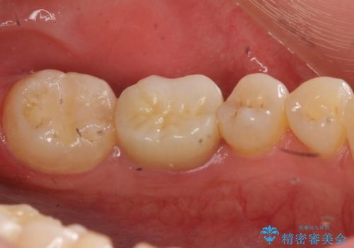 欠けた詰め物 セラミッククラウンでの修復の治療後