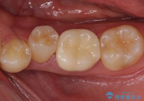 奥歯の詰め物の変色 セラミッククラウンでのやり替えの治療後