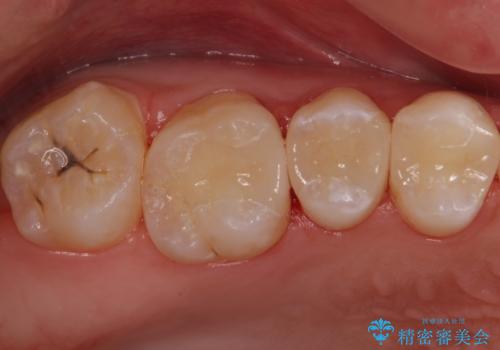 放置した虫歯 セラミックインレーでの治療の治療後