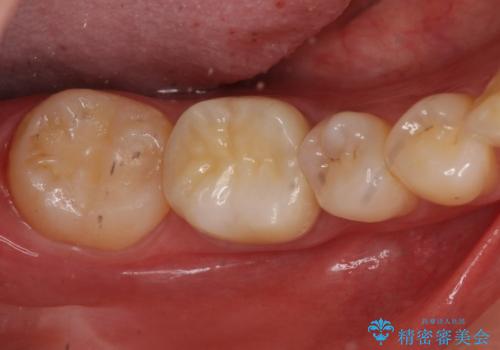 欠けた詰め物 セラミッククラウンでの修復の症例 治療後