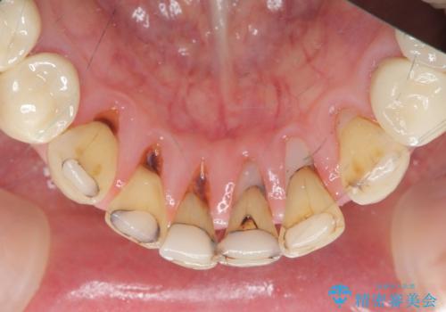 シェーグレン症候群で多発した虫歯　前歯のセラミック治療の治療前