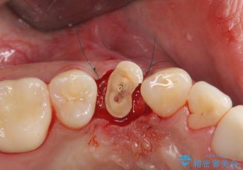 保険治療では抜歯適応になる歯 抜歯せずに保存(エクストリュージョン)の治療中