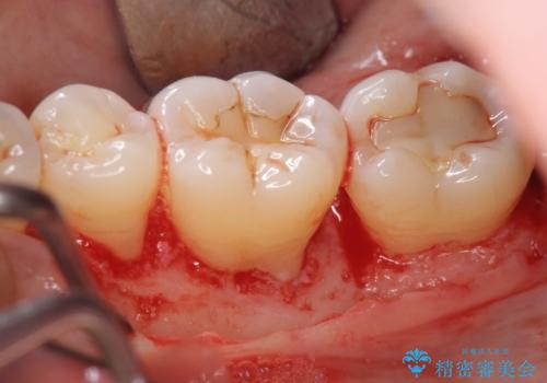 [ 歯周病 ]　歯を残す再生治療の治療中