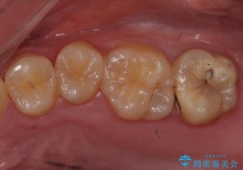 奥歯の放置した虫歯　セラミックでの治療の治療前
