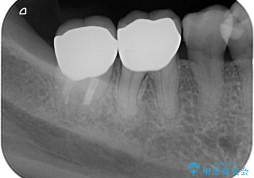 【オールセラミッククラウン】他院で治療した被せものが外れたの治療後