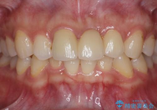 前歯のブリッジ治療の治療後