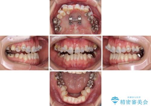 急速拡大装置　前歯の反対咬合をインビザラインで改善の治療中