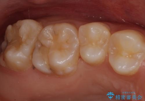 親知らずの手前の歯　抜歯後に適合の良いインレーでの修復処置の症例 治療前