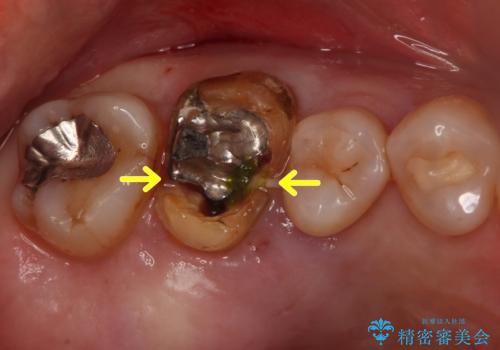割れた奥歯 適合の良いジルコニアブリッジでの治療