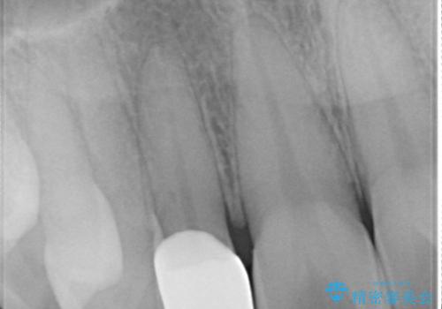 【オールセラミッククラウン】矮小歯の治療の治療後