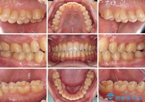 オープンバイトと目立つ銀歯 インビザライン矯正とセラミック修復治療の治療後