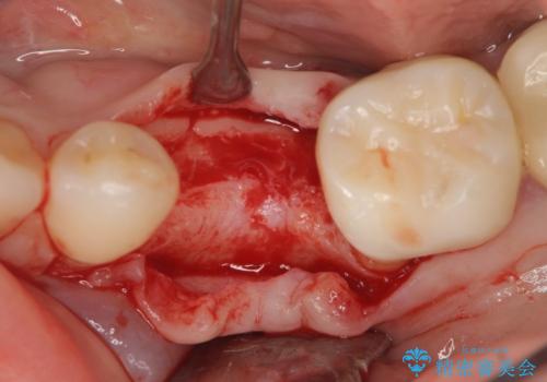 乳歯がぐらついてきた インプラントを用いた機能回復の治療中