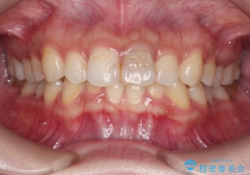 前歯のブリッジ治療の治療前