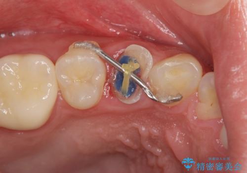 保険治療では抜歯適応になる歯 抜歯せずに保存(エクストリュージョン)の治療中