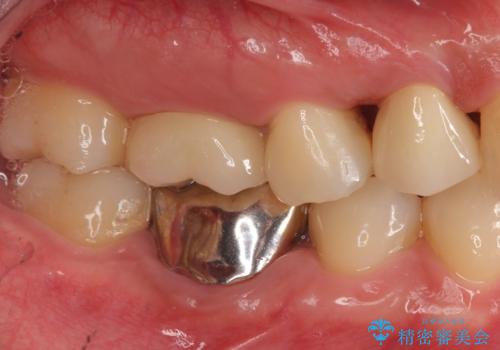 保険治療では抜歯適応になる歯　抜歯せずに保存(エクストリュージョン)の治療後
