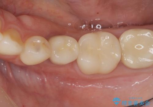 乳歯がぐらついてきた インプラントを用いた機能回復の治療後