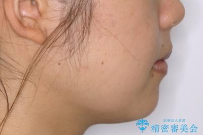 前歯のがたつきを改善してしっかり噛める歯並びへ:インビザライン治療の治療後(顔貌)