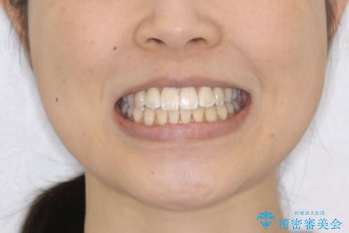 前歯のがたつきとオープンバイト:インビザラインでまとめて治すの治療後（顔貌）