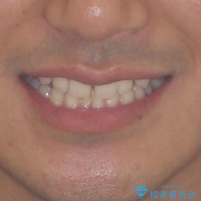 著しいディープバイトと隙間だらけの歯列　の治療前（顔貌）