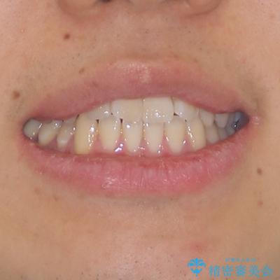 軽微なデコボコを安価に インビザライン・ライトによる矯正治療の治療前(顔貌)