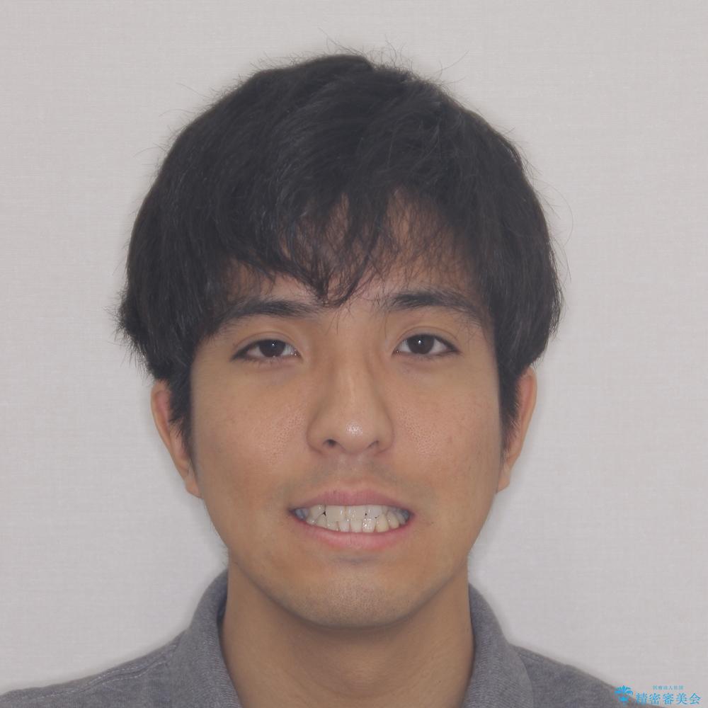 【モニター】左右のクロスバイトをインビザラインできれいに改善の治療前(顔貌)