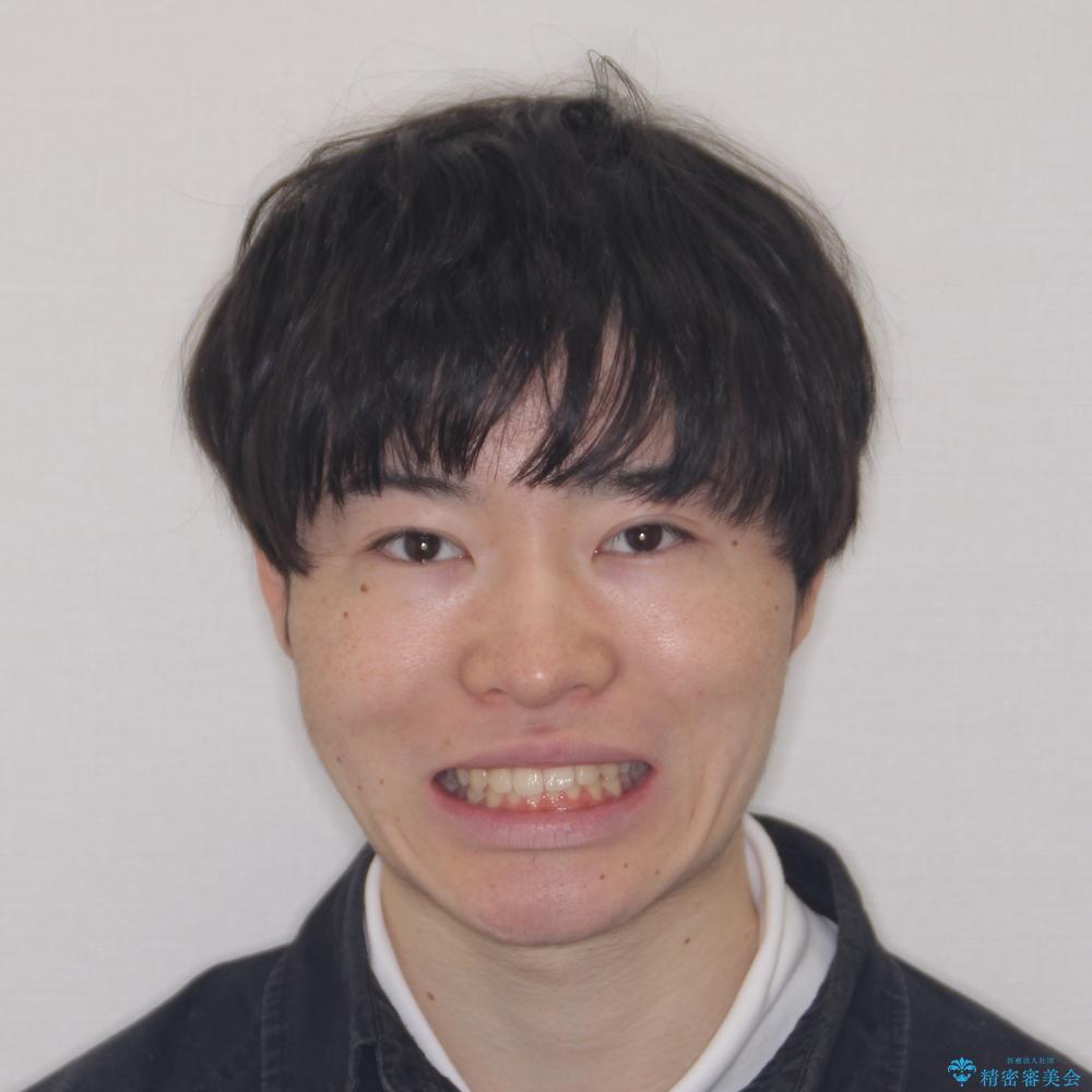 【モニター】斜めに突き出した前歯をインビザラインで改善の治療前(顔貌)