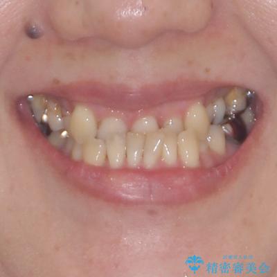 急速拡大装置　前歯の反対咬合をインビザラインで改善の治療前（顔貌）