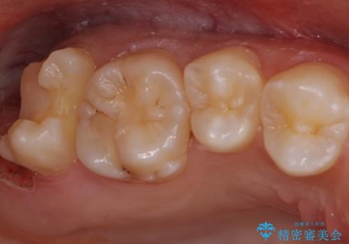 親知らずの手前の歯　抜歯後に適合の良いインレーでの修復処置の治療中