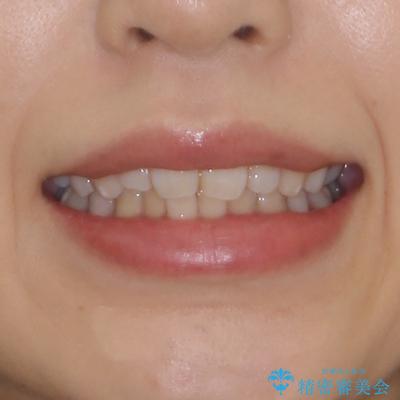 インビザライン・ライトで抜歯矯正の後戻りを解消の治療前(顔貌)