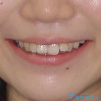 目立たない裏側矯正で突出感を改善 ハーフリンガル矯正の治療前(顔貌)