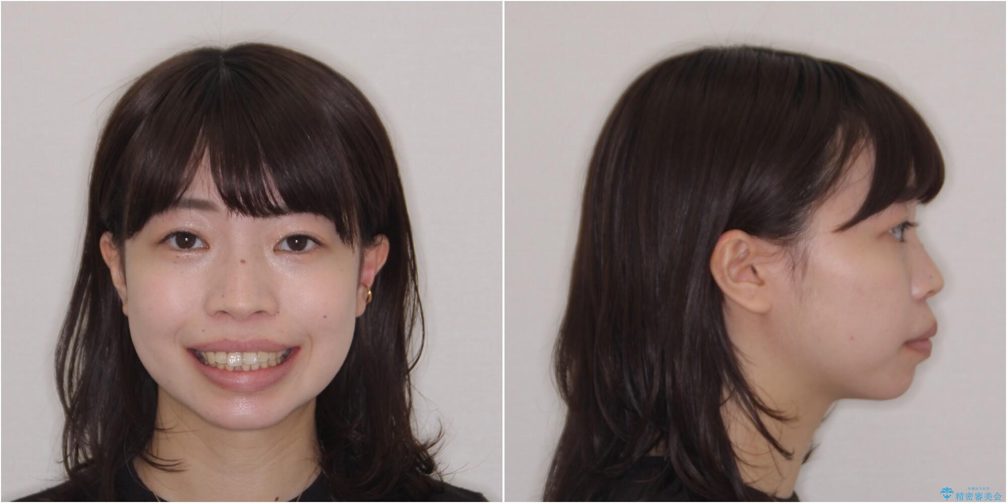【モニター】短期間で口の閉じにくさを改善　ワイヤー装置での抜歯矯正の治療前（顔貌）