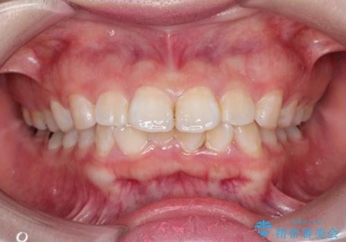 【抜歯矯正】口元を下げたい!の治療前