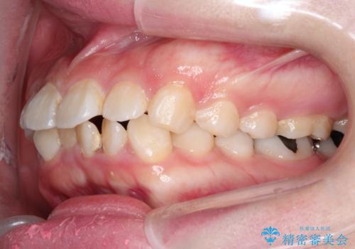 【抜歯矯正】口元を下げたい!の治療前