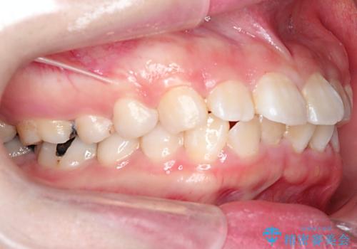 【抜歯矯正】口元を下げたい!の治療前