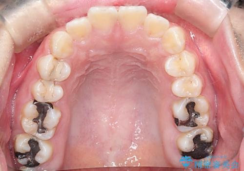 【抜歯矯正】口元を下げたい!の治療前