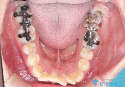 【抜歯矯正】口元を下げたい!の治療前