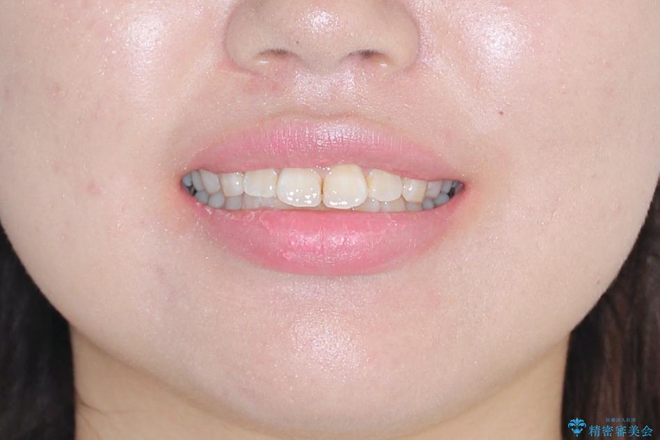 【抜歯矯正】口元を下げたい!の治療前(顔貌)