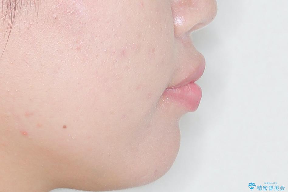 【抜歯矯正】口元を下げたい!の治療前(顔貌)