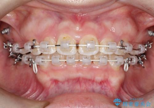 【抜歯矯正】口元を下げたい!の治療中