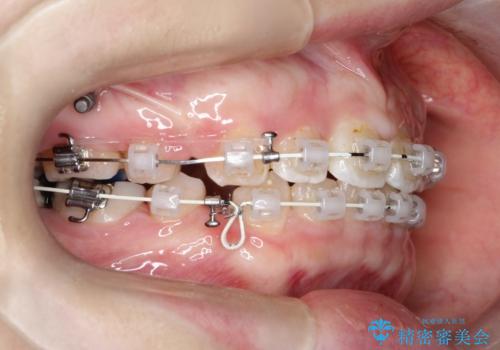 【抜歯矯正】口元を下げたい!の治療中